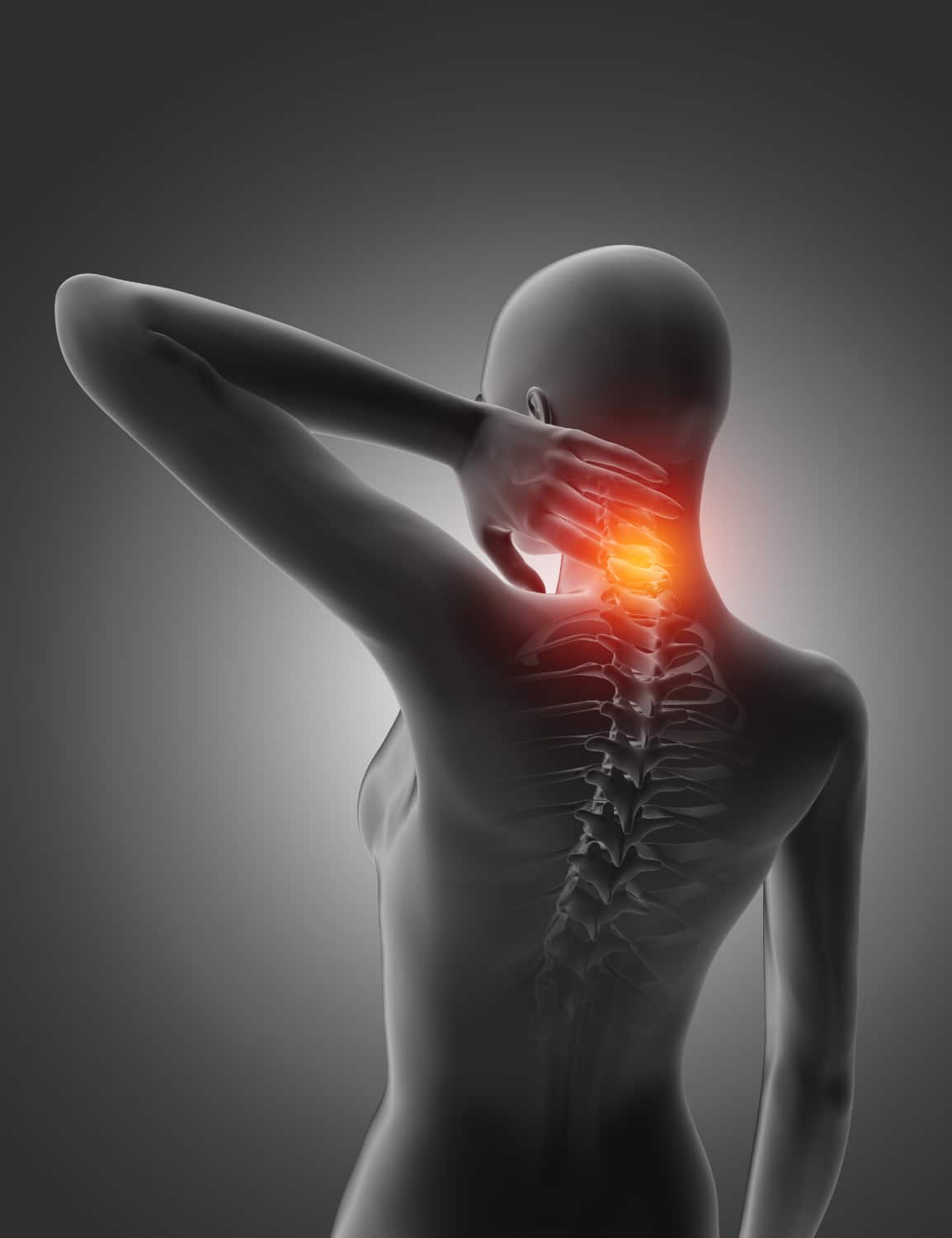 Ilustração 3D de figura humana com dor cervical destacada em laranja e vermelho, representando a dor crônica tratada com cannabis para fibromialgia