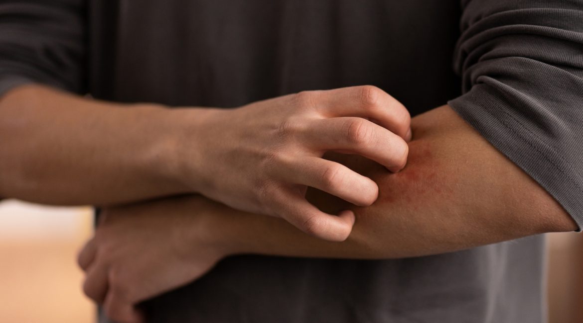 Pessoa coçando o braço com vermelhidão na pele, ilustrando os sintomas de coceira e inflamação da dermatite e psoríase tratadas com cannabis